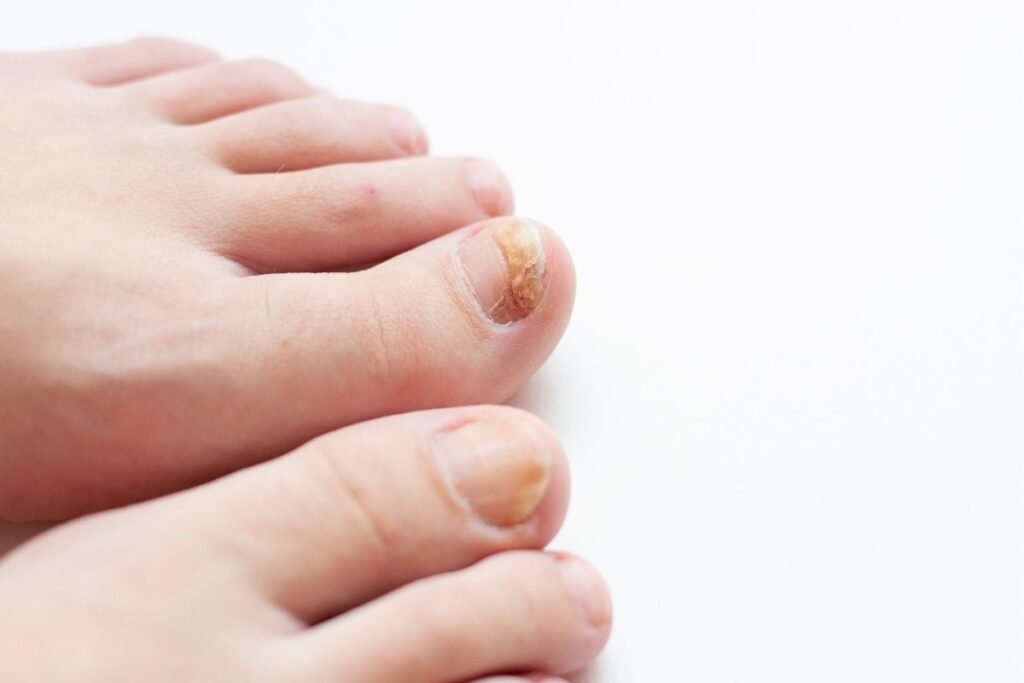 Neglesopp på tærne: Effektive kurer du kan starte i dag